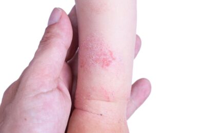 How to Treat Baby Eczema